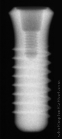 Radiograph of Stage-1 WDS