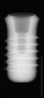 Radiograph of Stage-1 WDS