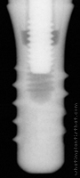 Radiograph of Stage-1