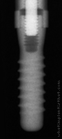 Radiograph of Standard Plus NN