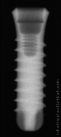 Radiograph of SybronPro TL