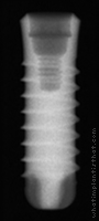 Radiograph of SybronPro TL