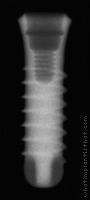 Radiograph of SybronPro TL