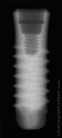 Radiograph of SybronPro TL