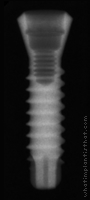 Radiograph of SybronPro TL