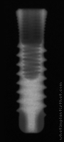 Radiograph of SybronPro XRT