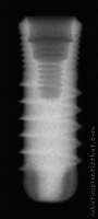 Radiograph of SybronPro XRT