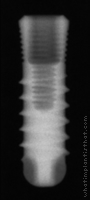 Radiograph of SybronPro XRT