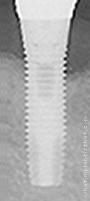 Radiograph of TG (Transgingival)