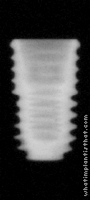 Radiograph of Osstem TSIII