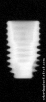 Radiograph of Osstem TSII