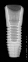 Radiograph of Astra Tech TX Profile