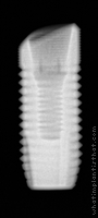 Radiograph of Astra Tech TX Profile S