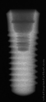 Radiograph of Tapered Effect RN