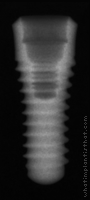 Radiograph of Tapered Effect RN