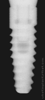 Radiograph of Tapered Internal RBT, Laser-Lok