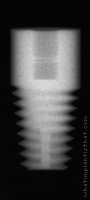 Radiograph of Tapered Root Form