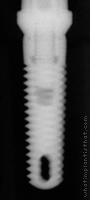 Radiograph of Tapered Screw-Vent