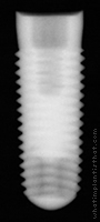 Radiograph of Tapered Screw-Vent