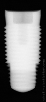 Radiograph of Tapered Screw-Vent