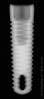 Radiograph of Tapered Screw-Vent