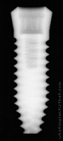 Radiograph of Two-Piece Taper Screw (TSI)