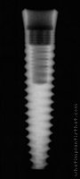 Radiograph of Two-Piece Taper Screw (TSI)