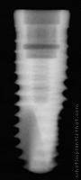 Radiograph of Friadent XiVE S Plus