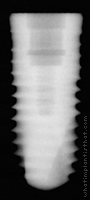 Radiograph of Friadent XiVE S Plus