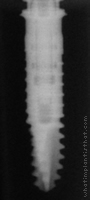 Radiograph of Friadent XiVE S Plus