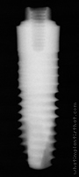 Radiograph of Friadent XiVE TG Plus