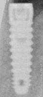 Radiograph of Micro-Vent 2