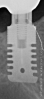 Radiograph of Rex TL 2.9