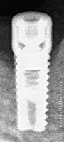 Radiograph of DFI