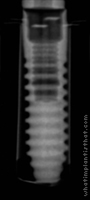 Radiograph of Laser-Lok