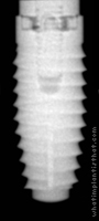 Radiograph of Bio-Lok Laser-Lok I.C.