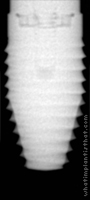 Radiograph of Bio-Lok Laser-Lok I.C.