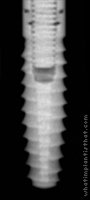 Radiograph of Bio-Lok Silhouette I.C.