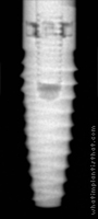 Radiograph of Bio-Lok Silhouette I.C.