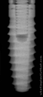 Radiograph of Bio-Lok Silhouette Screw