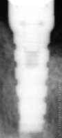 Radiograph of Sybron Anatomic