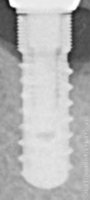 Radiograph of BioLife