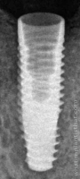 Radiograph of Neodent Helix GM