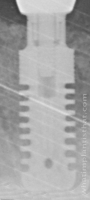 Radiograph of Rex TL 2.9