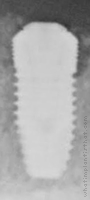 Radiograph of Implantium