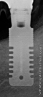 Radiograph of Rex TL 1.8