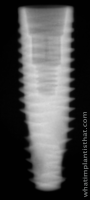 Radiograph of Neodent Helix GM