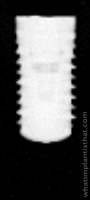 Radiograph of Bone Level RC