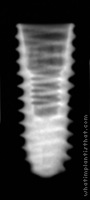 Radiograph of ET III