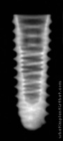 Radiograph of ET III